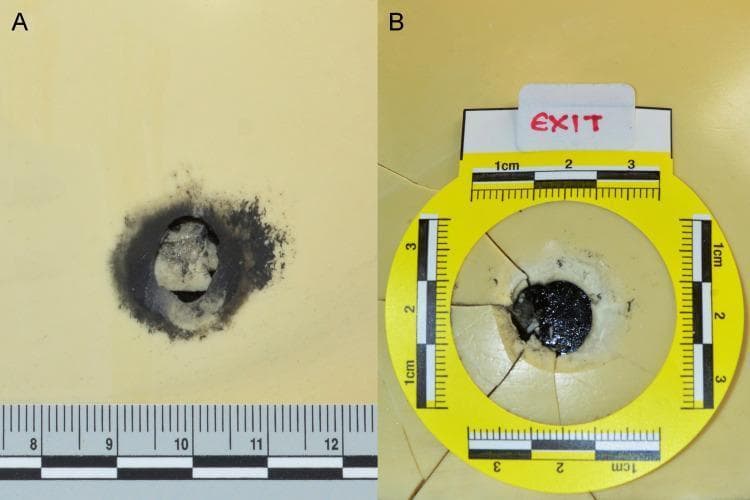 Educational forensic pathology specimens demonstrating terminal ballistics on a bone model. Image A displays an entrance wound characterized by a circular perforation with inward-protruding margins and a prominent ring of dark soot deposition, indicating a close-range or contact discharge. A metric scale shows the entrance diameter is approximately 10mm. Image B illustrates an exit wound with characteristic external beveling and radiating linear fractures extending from the circular defect. A yellow circular forensic scale is placed around the exit site for measurement. These specimens serve to educate on the differentiating morphological features between entrance and exit gunshot wounds, specifically focusing on marginal soot, beveling orientation, and fracture patterns used in forensic investigations to determine projectile trajectory and range of fire.