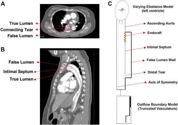 This composite educational resource illustrates Type B Aortic Dissection (TBAD) through diagnostic imaging and idealized modeling. Panel A is an axial contrast-enhanced CT scan of the thorax demonstrating a dissected descending aorta. It clearly identifies the True Lumen (TL), the typically larger False Lumen (FL), and the connecting intimal tear that allows communication between them. Panel B presents a sagittal CT reconstruction, showing the longitudinal extent of the dissection. The intimal septum is visible separating the anteriorly positioned true lumen from the posterior false lumen. Panel C is a corresponding schematic diagram used for hemodynamic modeling. It labels key anatomical and clinical features including the Varying Elastance Model (representing the left ventricle), the ascending aorta, an implanted endograft, the intimal septum, the false lumen wall, and the distal re-entry tear. The schematic outlines the axis of symmetry and the outflow boundary model for truncated vasculature. This content is designed to teach the spatial relationships of aortic dissection and the biomechanical parameters relevant to Thoracic Endovascular Aortic Repair (TEVAR).