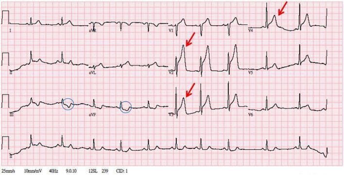 A 12-lead electrocardiogram (ECG) demonstrating signs consistent with an acute ST-elevation myocardial infarction (STEMI) of the anterior wall. The tracing shows marked ST-segment elevation in the precordial leads, specifically from V1 through V4, as indicated by red arrows. Notable findings include hyperacute T waves in leads V2 and V3, which appear tall, peaked, and symmetrical. Reciprocal ST-segment depression is visible in the inferior leads III and aVF (highlighted with blue circles), a classic finding in anterior wall ischemia. The rhythm appears to be a sinus rhythm with a normal heart rate. Other leads, including I, II, aVR, aVL, V5, and V6, show relatively preserved morphology without significant acute deviations. This visual material is used to teach the recognition of early ischemic changes, including the identification of hyperacute T waves and the diagnostic criteria for anterior STEMI, emphasizing the anatomical correlation with the left anterior descending (LAD) coronary artery distribution.