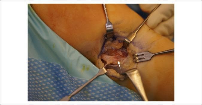 Intraoperative clinical photograph of a peripheral nerve decompression surgery in the lateral compartment of the leg near the fibular head. The image displays the common peroneal nerve (CPN) exposed through a surgical incision, with various stainless steel retractors (including Senn and rake-style retractors) providing visualization. A white arrow points to a distinct transverse demarcation line on the CPN, representing the specific site of chronic compression. Proximally (to the left of the arrow), the nerve exhibits morphological changes consistent with edema and swelling. Distally (to the right of the arrow), the nerve appears significantly flattened or compressed. This visual illustrates the focal pathology often associated with compressive neuropathies caused by external structures such as an osteochondroma or tight crural fascia. The image serves as an educational reference for identifying nerve compression characteristics and surgical anatomy during neurolysis or decompression procedures.