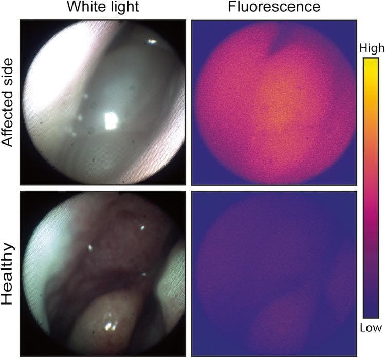 This composite diagnostic image demonstrates in vivo fluorescence molecular imaging (FMI) during endoscopic sinus surgery for sinonasal inverted papilloma (SNIP). The figure is arranged in a 2x2 grid comparing the 'Affected side' (top row) with the 'Healthy side' (bottom row) under 'White light' (left column) and 'Fluorescence' (right column) imaging modalities. In the white light images, the affected tissue appears pale, smooth, and less vascularized compared to the reddish, highly vascularized normal mucosa on the healthy side. The corresponding fluorescence images utilize a pseudocolor heatmap (indicated by a vertical scale from blue/low to yellow/high) to represent bevacizumab-800CW tracer uptake, which targets VEGF-A. The affected side shows a high-intensity, concentrated yellowish-orange signal, indicating significant tracer accumulation and VEGF-A expression. Conversely, the healthy side exhibits a low-intensity, dark purple/blue signal, representing minimal background fluorescence. This comparison illustrates the clinical utility of targeted FMI in differentiating pathological sinonasal tissue from healthy mucosa based on molecular markers.