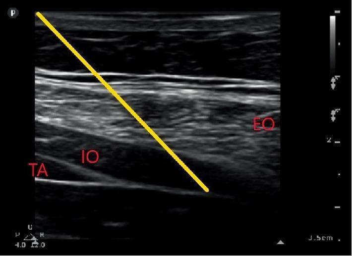 This diagnostic ultrasound image demonstrates the layered anatomy of the lateral abdominal wall for the purpose of guiding a transversus abdominis plane (TAP) or quadratus lumborum (QL) block. The image shows three distinct muscular layers: the superficial external oblique (EO), the intermediate internal oblique (IO), and the deep transversus abdominis (TA) muscle. These structures appear as hypoechoic bands separated by hyperechoic fascial planes. A prominent yellow line overlay indicates the simulated needle trajectory, originating from the top left and progressing diagonally toward the posterior aponeurosis of the transversus abdominis muscle. The clinical focus is on identifying the precise fascial interface for local anesthetic delivery to provide regional anesthesia. Landmarks such as the transversalis fascia and the relationship between muscle bellies and their aponeurotic extensions are clearly visible, serving as a pedagogical tool for ultrasound-guided regional anesthesia techniques in perioperative pain management.