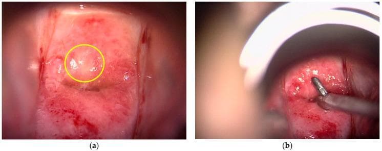 This clinical photograph displays colposcopic findings of the uterine cervix in two panels, focusing on Cervical Intraepithelial Neoplasia (CIN) and diagnostic procedures. Panel (a) shows the cervix after the application of acetic acid, revealing a predominantly pinkish-red mucosal surface. A yellow circle highlights a localized area of thin acetowhite epithelium, a key colposcopic marker for neoplastic change where the tissue appears paler and more opaque than the surrounding mucosa. Panel (b) captures a punch biopsy (P-Bx) procedure performed under colposcopic guidance. Metallic, silver-colored punch biopsy forceps are seen grasping a targeted area of the suspicious cervical tissue. The surrounding tissue in this panel appears hyperemic, glistening, and moist, with minor surface bleeding visible, which is common during the biopsy process. These images demonstrate the transition from visual screening using the Rio 2011 Colposcopy Nomenclature to tissue acquisition for histological confirmation of high-grade CIN lesions.
