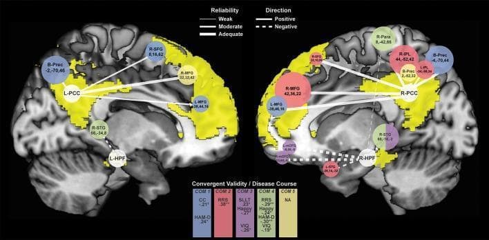 This diagnostic image consists of two sagittal-view brain diagrams illustrating functional magnetic resonance imaging (fMRI) connectivity clusters in the Default Mode Network (DMN), specifically comparing remitted Major Depressive Disorder (rMDD) and healthy controls. The left panel shows connectivity from the left Posterior Cingulate Cortex (L-PCC) seed, while the right panel highlights the right Posterior Cingulate Cortex (R-PCC) and hippocampal formation (HPF) seeds. Key regions identified with MNI coordinates include the bilateral Precuneus (B-Prec), Middle Frontal Gyrus (MFG), and Superior Frontal Gyrus (SFG). Solid lines indicate positive connectivity (hyperconnectivity in rMDD), while dotted lines represent negative connectivity (hypoconnectivity). The thickness of these lines denotes reliability levels (weak, moderate, adequate). Colored circles represent different components (COM 1-5) and are scaled by cluster size. The diagram serves as a pathophysiology illustration demonstrating how DMN connectivity abnormalities—specifically between the PCC, prefrontal cortex, and hippocampus—relate to clinical features like rumination (RRS) and depressive symptoms (HAM-D) in individuals with remitted depression.