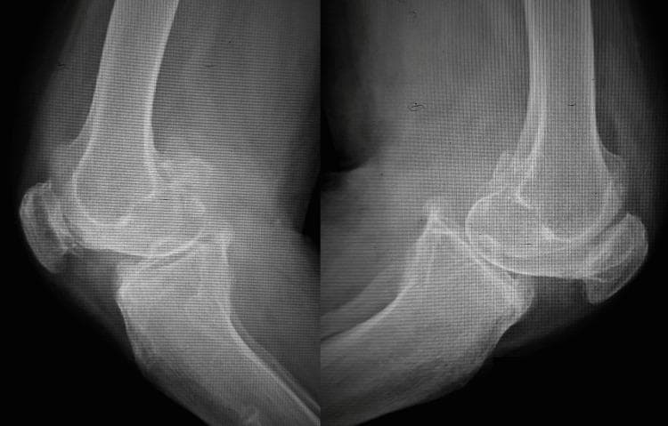 Lateral view X-ray radiography of bilateral knee joints demonstrating advanced degenerative joint disease consistent with Kellgren-Lawrence Grade IV osteoarthritis. The imaging reveals a near-total loss of the tibiofemoral joint space, indicating complete cartilage erosion. Prominent osteophyte formation (bony spurs) is visible on the anterior and posterior aspects of the distal femur and proximal tibia, as well as the superior and inferior poles of the patella. Key radiographic features include significant subchondral sclerosis, characterized by increased bone density at the joint surfaces, and subchondral cyst formation. The alignment shows structural deformity with signs of knee flexion contracture. These findings highlight chronic, severe mechanical degeneration affecting the articular cartilage and underlying bone structure of the femur, tibia, and patellofemoral compartments.