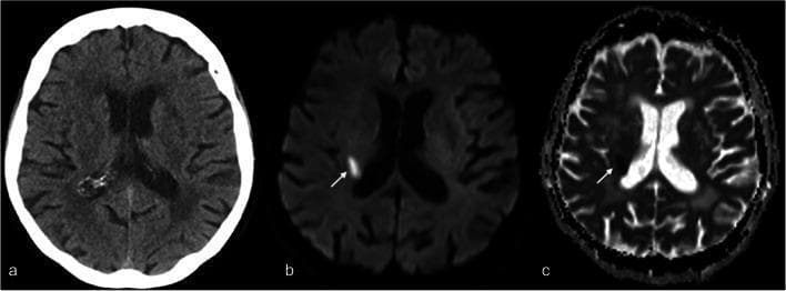 This diagnostic comparison highlights a CT-occult minor stroke in the axial plane of the brain. The panel includes three images: (a) a non-contrast CT (NCCT), (b) a diffusion-weighted MRI (DWI, b=1000), and (c) a corresponding Apparent Diffusion Coefficient (ADC) map. In the NCCT image, the brain parenchyma appears normal without focal density changes or evidence of intracranial hemorrhage or large-vessel ischemia. In contrast, the DWI scan (b) reveals a distinct focal area of hyperintensity (bright signal) in the posterior limb of the right internal capsule, as indicated by the white arrow. This finding is matched in the ADC map (c) by a corresponding area of hypointensity (dark signal), confirming cytotoxic edema and restricted diffusion. This pattern is pathognomonic for an acute ischemic infarction. The comparison demonstrates the superior sensitivity of MRI short-protocols over standard CT for detecting small, acute lacunar or minor strokes in patients presenting with transient neurological symptoms like mild hemiparesis.