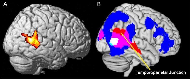 This diagnostic figure displays functional MRI (fMRI) data overlaid onto a 3D brain template to illustrate cortical activation during action observation. Figure A features a lateral view of the right hemisphere with a colored statistical map indicating activation in the posterior superior temporal sulcus (STS). The heat map intensity ranges from red (low) to yellow/white (high). Figure B presents a multi-color overlay on the ch2better template using MRIcron to show spatial conjunctions. Blue regions represent general action observation tasks, primarily located in the frontal and parietal lobes. Red regions highlight significant 'interacted regions' at the right temporoparietal junction (TPJ), as indicated by a yellow arrow. Pink areas signify the conjunction of action observation and interacted regions. Small light blue and white areas represent higher-order intersections of three experimental contrasts. This comparison distinguishes between regions for general motion processing (STS) and those specific to social cognition and effort inference (TPJ).
