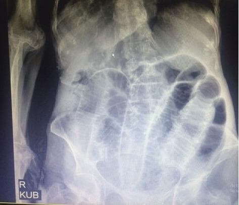 This diagnostic image is a supine abdominal X-ray (KUB) demonstrating multiple dilated small bowel loops, characteristic of a small bowel obstruction. The dilated loops are primarily distributed throughout the central abdominal cavity and exhibit visible valvulae conniventes (plicae circulares) extending across the full width of the lumen, distinguishing them from large bowel haustra. The image shows horizontal interfaces consistent with air-fluid levels within the distended loops. These radiographic findings indicate a significant intestinal blockage, which in this clinical context was associated with a perforated Meckel's diverticulum and an internal hernia. The anatomical focus includes the mid-to-lower abdomen, providing a clear example of obstructive ileus suitable for medical students and clinicians studying emergency radiology and gastrointestinal pathology.
