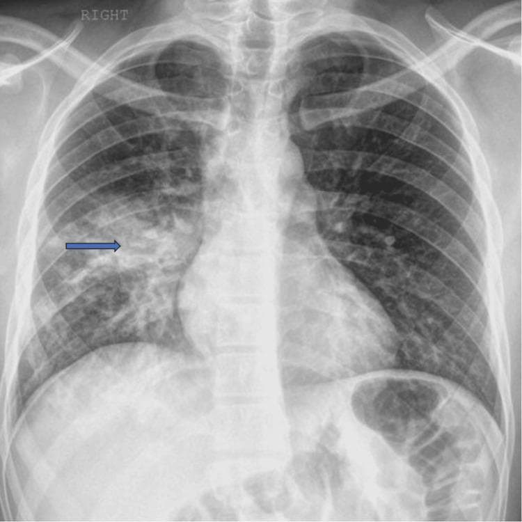 This diagnostic image is a posterior-anterior (PA) chest X-ray demonstrating common radiographic features of focal pneumonia. The primary finding is located in the right lung field, where patchy airspace opacities and an area of pulmonary consolidation are visible, highlighted by a blue arrow. The consolidation is characterized by increased density that obscures the underlying pulmonary vasculature, consistent with fluid or inflammatory exudate replacing air in the alveoli. The left lung field appears clear without similar focal opacities. The mediastinal contours, including the cardiac silhouette and trachea, are within normal limits. The costophrenic angles are sharp, suggesting the absence of significant pleural effusion. Bony structures, including the ribs, clavicles, and vertebrae, as well as the surrounding soft tissues, show no acute abnormalities. This image serves as a clinical example of localized infectious process, such as community-acquired pneumonia, in an adult patient.