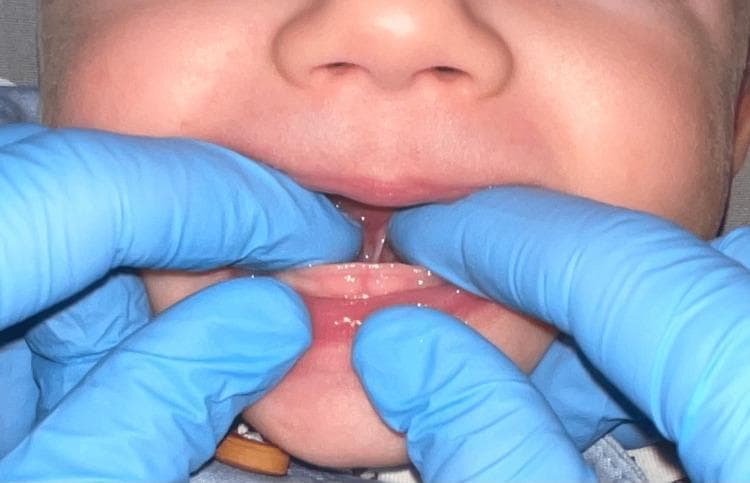 A clinical photograph of an infant's oral cavity during a physical examination for ankyloglossia (tongue-tie). Gloved fingers are shown retracting the lower lip and elevating the tongue to expose the sublingual region. The image demonstrates a prominent lingual frenulum, characterized as a thin, translucent membrane that appears short and restrictive. The frenulum attaches from the ventral surface of the tongue, near the anterior tip, down to the floor of the mouth in close proximity to the mandibular alveolar ridge. This anterior attachment and short length indicate a restricted range of motion for the tongue, characteristic of Coryllos grade 3 or similar classifications of ankyloglossia. This visual is intended for dental and pediatric education regarding the diagnostic appearance of symptomatic lingual frenula in breastfeeding infants.