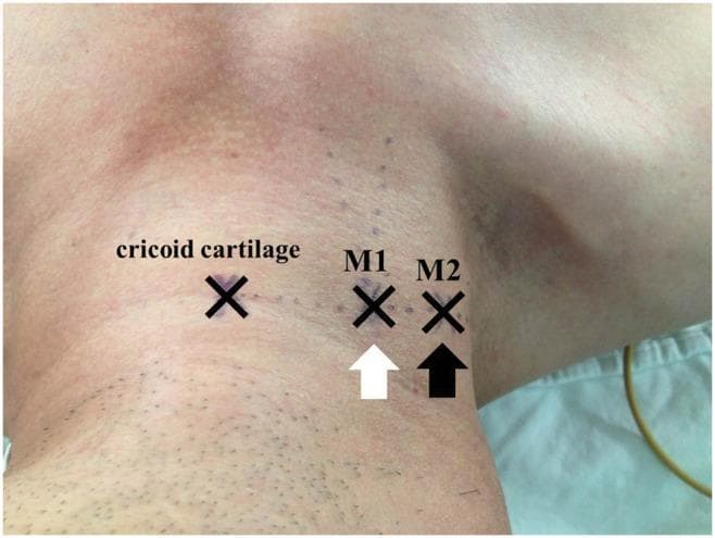 A clinical photograph of the right lateral neck of a patient in a supine, head-down position, demonstrating surface anatomical landmarks for internal jugular vein (IJV) catheterization. Three 'X' markings are visible along a horizontal line at the level of the cricoid cartilage. The leftmost mark indicates the cricoid cartilage itself. The central mark, labeled 'M1' and indicated by a white arrow, represents the apex of the triangle formed by the sternal and clavicular heads of the sternocleidomastoid muscle. The lateral mark, labeled 'M2' and indicated by a black arrow, represents an alternative landmark identified by observing respiratory jugular venodilation and manual palpation of the IJV. The image illustrates the spatial relationship between traditional surface landmarks and dynamic physiological markers (venodilation) used to improve the accuracy of central venous access. Subtle skin elevations near M2 correspond to underlying venous distension, providing clinical guidance for needle insertion in the absence of ultrasound.