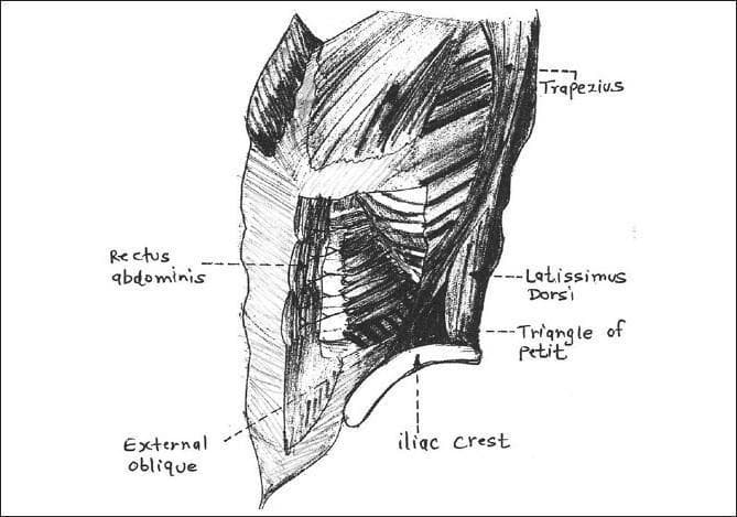 This medical anatomical diagram is a posterior-lateral sketch of the human torso, illustrating the musculature and boundaries of the lumbar triangle, also known as the Triangle of Petit. The diagram highlights the clinical significance of this region for procedures such as the transversus abdominis plane (TAP) block. The anatomical boundaries are clearly labeled: the posterior border is formed by the latissimus dorsi muscle, the anterior border by the external oblique muscle, and the base (inferior border) by the iliac crest. Other visible anatomical landmarks include the rectus abdominis muscle, located medially and anteriorly, and the trapezius muscle superiorly. The illustration demonstrates the convergence of these muscular structures to form a small, triangular area of relative weakness in the abdominal wall, which is a potential site for lumbar hernias. This diagram is designed for educational use in anatomy, regional anesthesia, and general surgery to help students and clinicians identify surface landmarks and deep structural relationships in the lumbar region.