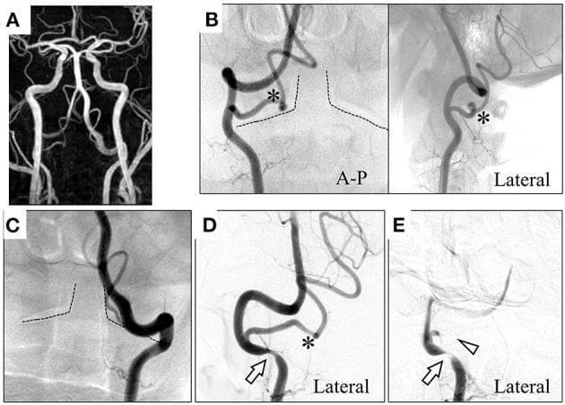 Educational neuroimaging series demonstrating dynamic vertebral artery compression in Bow Hunter's Syndrome. Image (A) is a maximum intensity projection MRA showing bilateral vertebral arteries (VAs) merging into the basilar artery, with left-sided dominance. Images (B) and (C) are Digital Subtraction Angiography (DSA) frames in anterior-posterior and lateral views identifying anatomical variations: the right posterior inferior cerebellar artery (PICA, marked with an asterisk) originates at the C1-C2 level and enters the spinal canal. Images (D) and (E) show dynamic DSA during head rotation. At 45° leftward rotation (D), there is focal narrowing/compression of the right VA at the V3 segment (arrow). At 60° rotation (E), the compression of the right VA worsens (arrow) and the right PICA becomes completely occluded (arrowhead). This sequence illustrates rotational occlusion of the posterior circulation, a hallmark of Bow Hunter's Syndrome caused by mechanical compression during cervical rotation at the atlantoaxial level.