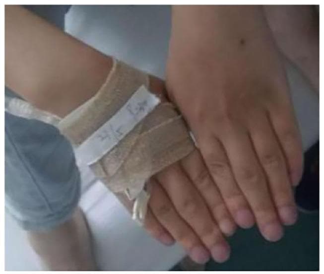 This clinical photograph displays the hands of a patient exhibiting clear signs of chronic hypoxemia and inflammatory changes. The primary visible pathology includes marked digital clubbing, characterized by the bulbous enlargement of the distal phalanges and a loss of the normal angle between the nail plate and the proximal nail fold. The fingernails and distal fingertips demonstrate a bluish-purplish discoloration consistent with peripheral cyanosis. Additionally, there is noticeable fusiform swelling of the proximal interphalangeal (PIP) joints, particularly prominent on the middle fingers, suggesting an associated inflammatory or rheumatic process. One hand is partially obscured by a tan elastic bandage and adhesive tape around the wrist and dorsum, with a visible intravenous (IV) catheter line, indicating acute medical management. The combination of digital clubbing and cyanosis is clinically significant for underlying chronic respiratory or cardiovascular disease, such as the pulmonary interstitial fibrosis mentioned in the associated clinical context.