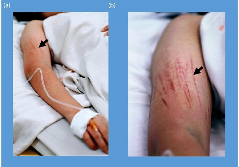 Clinical photograph of a patient's arm demonstrating bleeding manifestations characteristic of Dengue Shock Syndrome (DSS). The image is divided into two panels: (a) shows the full arm in a clinical setting with an intravenous (IV) line secured to the hand, and (b) provides a close-up view of the upper arm. Both panels highlight linear petechiae (indicated by black arrows), which are small, red to purplish hemorrhagic spots arranged in distinct linear patterns. These lesions represent microvascular fragility and are shown following the inflation of a blood pressure cuff (Hess test or capillary fragility test), a common diagnostic maneuver for assessing vascular permeability in dengue fever. The presence of an IV line and hospital bedding contextualizes the severity of the illness, illustrating the systemic plasma leakage and hemostatic dysfunction associated with severe viral hemorrhagic fevers. Key educational concepts include endothelial dysfunction, capillary fragility, and clinical signs of thrombocytopenia or vasculopathy.