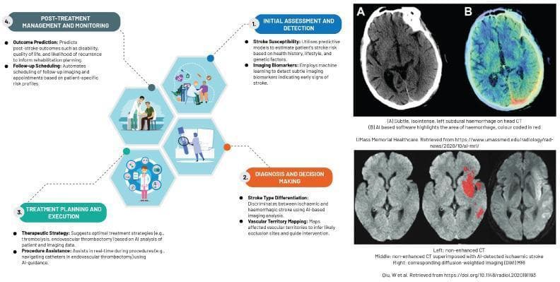 This infographic and diagnostic imaging panel illustrate machine learning applications in neuroradiology, specifically for stroke management. On the left, a flowchart describes a four-stage clinical cycle: 1) Initial Assessment (risk prediction and biomarkers), 2) Diagnosis and Decision Making (stroke type differentiation and vascular mapping), 3) Treatment Planning (therapeutic strategy and procedure assistance), and 4) Post-treatment Monitoring (outcome prediction and follow-up). The right panel provides diagnostic comparisons. The top section (A and B) displays an axial head CT showing a subtle left subdural hemorrhage, with Image B utilizing AI-based software to highlight the hemorrhagic area in red on a color-coded map. The bottom section compares three axial brain scans: a non-enhanced CT (left), an AI-augmented CT with red overlays highlighting an ischemic stroke (middle), and a corresponding Diffusion-Weighted Imaging (DWI) MRI (right) that confirms the ischemic area through restricted diffusion signal. The content serves as an educational overview of how artificial intelligence assists in detecting infarcts and hemorrhages while streamlining neuro-radiological workflows.