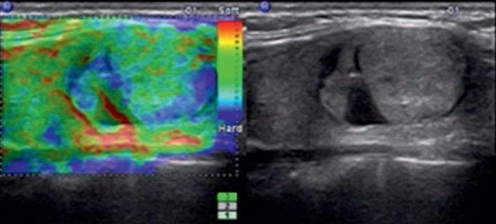 A dual-panel diagnostic ultrasound image of a 20 mm left thyroid nodule. The right panel displays a transverse B-mode (grayscale) ultrasound scan showing an isoechoic, well-circumscribed nodule with a smooth margin and a wider-than-tall orientation. The nodule lacks macro- or microcalcifications and possesses a mixed solid-cystic appearance. The left panel shows the corresponding real-time elastography (RTE) color map superimposed on the grayscale image. The elastography map utilizes a spectrum from red (soft) to blue (hard), with the nodule exhibiting a mosaic pattern of green and blue, indicating soft to intermediate tissue elasticity. This is quantitatively represented by an elasticity score (ES) of 2. These combined features align with a Thyroid Imaging Reporting and Data System (TI-RADS) category 3 classification, clinically consistent with a benign lesion such as nodular goiter.