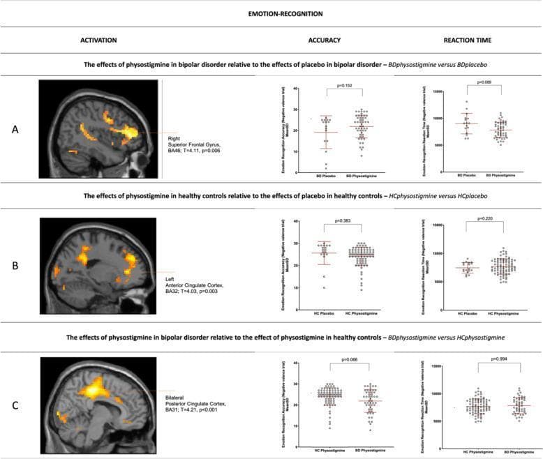 This composite educational graphic details the neurobiological effects of physostigmine during emotion-recognition tasks in Bipolar Disorder (BD) and Healthy Controls (HC). The image is organized into three comparative panels (A, B, C), each containing a functional MRI (fMRI) brain scan and corresponding behavioral dot plots for accuracy and reaction time. Panel A shows sagittal brain activation where physostigmine increases activity in the right superior frontal gyrus (Brodmann Area 46) in BD patients compared to placebo. Panel B illustrates decreased activation in the left anterior cingulate cortex (BA32) in healthy controls following physostigmine administration relative to placebo. Panel C displays a direct contrast between the two groups under physostigmine influence, highlighting increased activation in the bilateral posterior/dorsal cingulate cortex (BA31) in BD patients relative to controls. The behavioral data plots indicate that while neurofunctional activation patterns shifted significantly (p<0.05), behavioral performance regarding recognition accuracy and reaction times remained largely unchanged across groups. This material illustrates the differential cholinergic impact on frontocingulate circuits involved in emotional processing and top-down regulation in mood disorders.