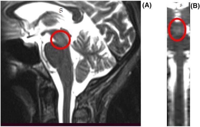 This diagnostic image consists of T2-weighted magnetic resonance imaging (MRI) of the brain and brainstem. (A) Sagittal view demonstrates the brainstem anatomy, including the midbrain, pons, medulla oblongata, and cervical spinal cord. A red circle highlights an area of scattered hyperintensity in the midbrain, specifically within its anterior aspect. Surrounding landmarks include the cerebellum posteriorly and hyperintense cerebrospinal fluid within the ventricular system and subarachnoid space. (B) Coronal reconstruction focuses on the brainstem and upper spinal cord, with a red circle indicating centrally located hyperintensities within the midbrain. The visible signal changes are consistent with a demyelinating process or neuroinflammatory condition. This visual material is intended for intermediate to advanced medical learners studying neuroradiology, specifically focusing on identifying brainstem lesions and interpreting signal abnormalities in demyelinating diseases such as multiple sclerosis or neuromyelitis optica spectrum disorder (NMOSD).
