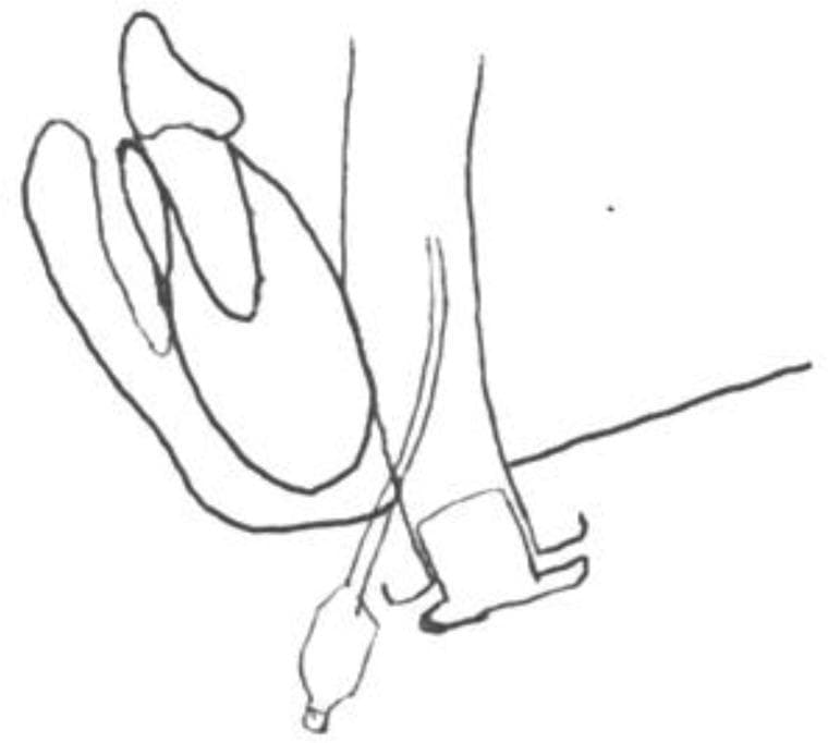 This medical illustration is a line diagram depicting the anatomical route of the original subperiosteal midline submental intubation technique. The diagram shows a sagittal-oblique view of the oral cavity and neck structures. Key anatomical landmarks include the mandible (anteriorly) and the floor of the mouth. An endotracheal tube is illustrated following a submental trajectory, entering from the submental skin through a midline incision and passing superiorly into the oral cavity, medial to the mandibular border. The cuff of the armored anesthetic tube is shown positioned in the sublingual space. The illustration highlights the spatial relationship between the intubation tube and the oral floor, designed to facilitate airway management in complex maxillofacial surgeries where oral or nasal intubation is contraindicated. This diagram serves as an educational tool for anesthesiology and oral-maxillofacial surgery, specifically demonstrating the Altemir technique and its associated anatomical risks, such as potential damage to sublingual vascular structures during subperiosteal dissection.