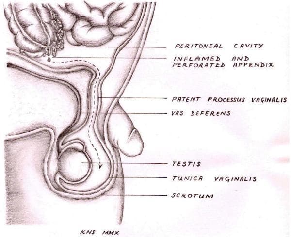 This medical anatomical diagram illustrates the pathophysiology of a scrotal abscess occurring as a rare complication of acute appendicitis. The sagittal view depicts the anatomical relationship between the peritoneal cavity and the scrotum. Key labeled structures include an 'inflamed and perforated appendix' situated superiorly, which is shown shedding purulent material. A dashed arrow traces the pathological pathway of the infection inferiorly through a 'patent processus vaginalis,' an embryonic developmental remnant. The diagram shows this channel passing adjacent to the 'vas deferens' and terminating in the 'scrotum,' where the 'testis' and 'tunica vaginalis' are located. This illustration serves to explain how intra-abdominal infection can track extra-abdominally into the scrotal sac when the processus vaginalis fails to obliterate. The diagram is intended for intermediate to advanced medical education, focusing on surgical anatomy, embryology, and atypical presentations of appendicitis.