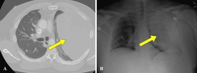 This diagnostic image set consists of an axial chest CT scan (A) and a corresponding frontal chest X-ray (B) demonstrating a massive left-sided pleural collection, identified as a hemothorax. In the CT scan (A), the left hemithorax is occupied by a large, homogenous fluid collection that exerts significant mass effect, leading to the complete compression and medial displacement of the left lung parenchyma (indicated by a yellow arrow) towards the mediastinum. The right lung appears well-aerated with normal vascular markings. In the X-ray (B), the left hemithorax exhibits near-complete opacification and volume expansion, resulting in a contralateral mediastinal shift to the right. The right lung remains visible, though partly obscured by the cardiac silhouette shift. This comparison illustrates the radiological presentation of a large-volume pleural effusion/hemothorax across different modalities, emphasizing lung collapse (atelectasis) and mediastinal displacement. Clinical context suggests this occurred as a complication during oncological treatment for synovial sarcoma.