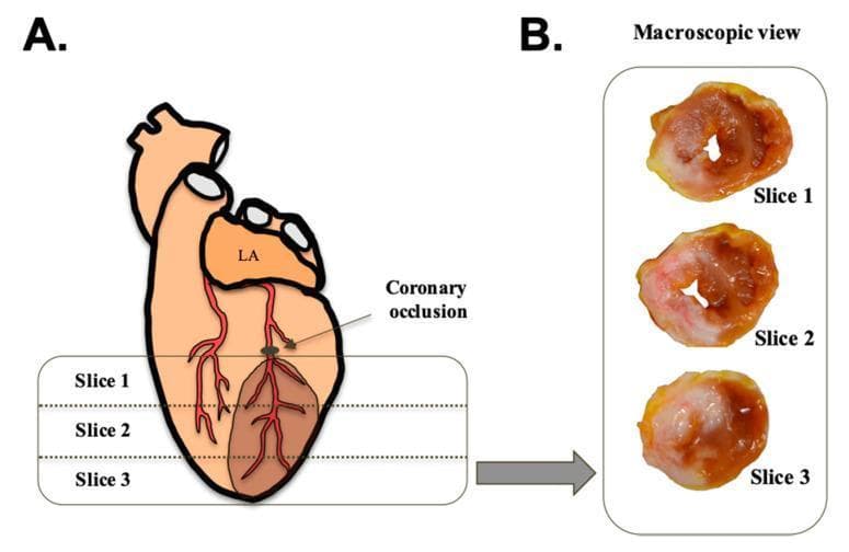 This medical figure illustrates the methodology and visual findings of an experimental myocardial infarction model. Panel A is an anatomical diagram showing a heart with a coronary occlusion placed on a coronary artery distal to the left atrium (LA). A shaded brown region extending inferiorly from the occlusion site represents the infarcted area. The diagram indicates the levels of three transverse ventricular sections labeled Slice 1, Slice 2, and Slice 3. Panel B displays corresponding macroscopic clinical photographs of these three cross-sectional heart slices stained with thioflavin-S under white light. The macroscopic view demonstrates the progression of tissue damage: Slice 1 (proximal) shows a localized area of pale, healthy tissue alongside darker necrotic regions; Slice 2 and Slice 3 (distal) exhibit increasingly larger areas of dark, necrotic tissue, indicating the transmural extent of the infarction throughout the left ventricle. This material is designed for cardiovascular pathology education, specifically illustrating the spatial relationship between arterial ligation and the resulting downstream myocardial necrosis.