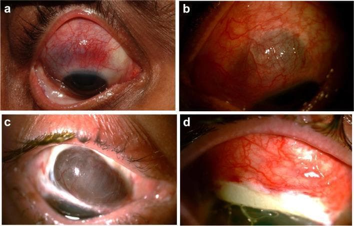This composite of four clinical photographs illustrates various stages and complications of necrotizing scleritis associated with Granulomatosis with Polyangiitis (GPA). Figure A displays an acute phase of necrotizing scleritis in the right eye, characterized by intense episcleral and scleral vascular congestion and localized areas of bluish discoloration indicating scleral thinning. Figure B shows similar active necrotizing scleritis in a left eye with diffuse hyperemia and haziness. Figure C demonstrates a severe complication of the disease process: significant superior scleral melt with subsequent uveal prolapse, visible as a dark, bulging mass where the scleral integrity has been lost. Figure D shows the postoperative appearance of the same eye following surgical intervention with a scleral patch graft to repair the defect. The graft is visible as a white, opaque tectonic support material integrated into the superior globe, with surrounding conjunctival injection and visible sutures. These images serve as educational examples of the destructive potential of systemic vasculitis on ocular collagenous tissues and the necessary surgical management of scleral perforation.