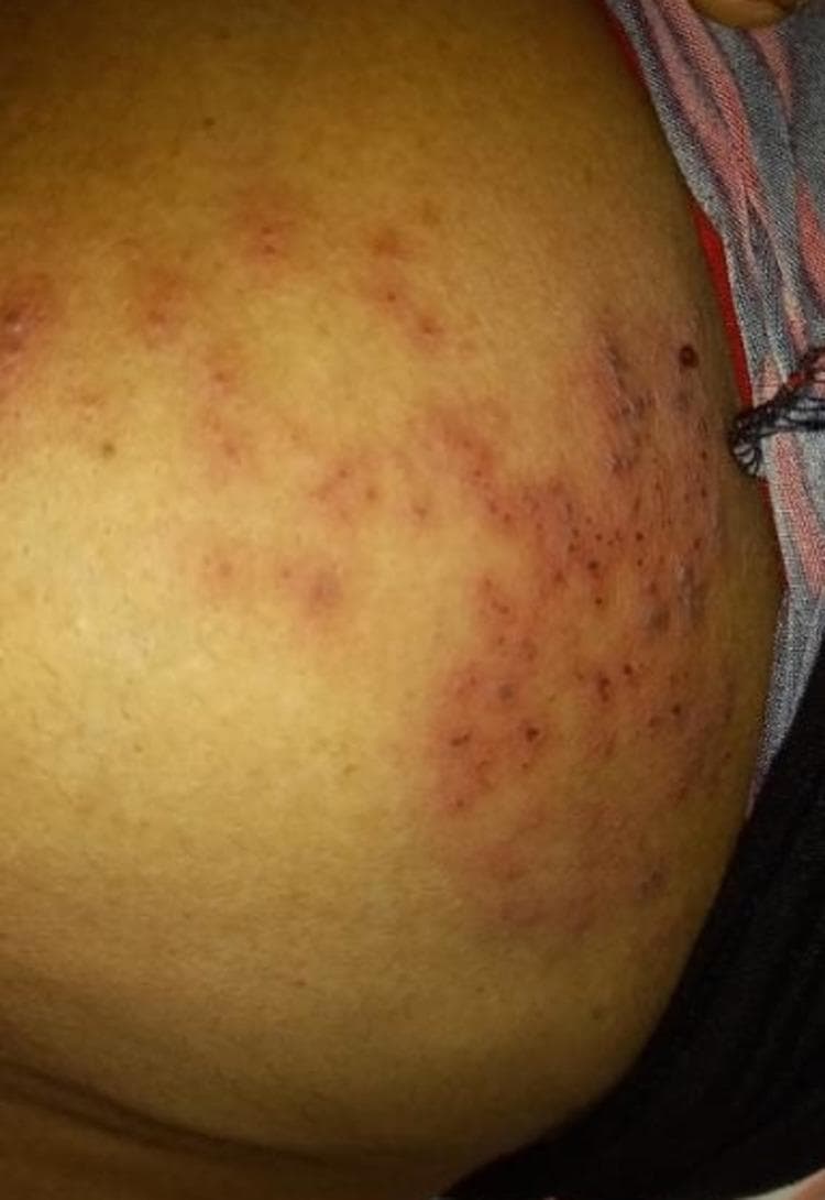 Clinical photograph of a patient's left chest wall demonstrating a localized, erythematous skin eruption. The lesions consist of multiple small, red papules and vesicles clustered in a dermatomal distribution corresponding to the T4 thoracic level. The rash is characterized by varying intensities of inflammation, ranging from light pink to dark red, set against a background of yellowish-brown skin. The distribution is unilateral and follows a clear neural pathway, which is highly suggestive of Herpes Zoster (shingles). This image serves as an educational example of dermatomal viral rashes and is relevant for medical training in infectious diseases and dermatology for identifying classic clinical presentations of varicella-zoster virus reactivation.