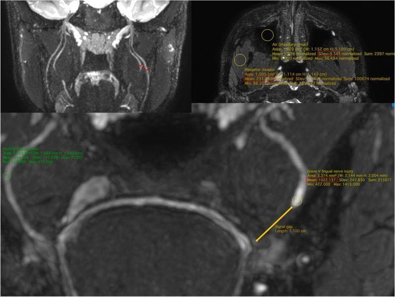 Diagnostic Magnetic Resonance Neurography (MRN) of the trigeminal nerve branches using coronal 3D CRANI sequences. The image is divided into panels demonstrating quantitative assessment methods for nerve injury. The upper panels show normal anatomy and calibration techniques: the left upper panel highlights the lingual nerve (LN) and inferior alveolar nerve (IAN) with regions of interest (ROI) at anatomical landmarks; the right upper panel shows ROI placement in the masseter muscle and maxillary sinus air to establish baseline signal intensity and noise for apparent signal-to-noise ratio (aSNR) calculations. The lower, enlarged panel demonstrates a Grade V lingual nerve injury (Sunderland classification). A definitive signal gap of 1.100 cm is measured between the proximal and distal nerve stumps, indicating complete transection. Numerical data overlays provide mean signal intensity and standard deviation within the ROIs, used to calculate the nerve-muscle contrast-to-noise ratio (aNMCNR). This imaging modality is used for surgical planning and objective stratification of post-traumatic nerve injuries in maxillofacial surgery.