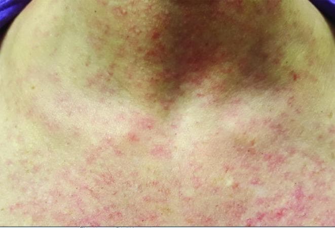 This clinical photograph displays a widespread maculopapular rash on a patient's neck and upper trunk. The rash is characterized by diffuse, erythematous lesions consisting of small, flat macules and slightly raised papules. The individual lesions are predominantly red, vary in size from pinpoint to several millimeters, and exhibit both discrete and confluent patterns. The distribution is dense across the anterior neck, supraclavicular regions, and the upper chest. This type of dermatological presentation is commonly associated with acute systemic viral infections, such as Zika virus (ZIKV), Chikungunya virus (CHIKV), or Dengue fever. The visual findings demonstrate an inflammatory response of the skin typical of viral exanthems, serving as a critical diagnostic sign in infectious disease and dermatology contexts.