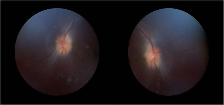 This diagnostic image consists of two fundoscopy circular frames showing the bilateral retinal fundi. The primary clinical finding is bilateral optic disc edema, consistent with grade 2 papilledema. The optic discs demonstrate significant blurring of the margins and visible elevation. Vascular changes include moderate engorgement and increased tortuosity of the retinal veins as they emerge from the disc. The physiological cups appear obscured due to the swelling. The surrounding retinal background maintains a normal red-orange hue, although there is a subtle presence of whitish spots suggestive of exudates in the peripheral field of the left eye. No obvious retinal hemorrhages are visualized. These findings are characteristic of increased intracranial pressure, as seen in conditions like idiopathic intracranial hypertension or space-occupying lesions. This content is intended for medical education in ophthalmology and neurology to demonstrate clinical signs of optic nerve head swelling.