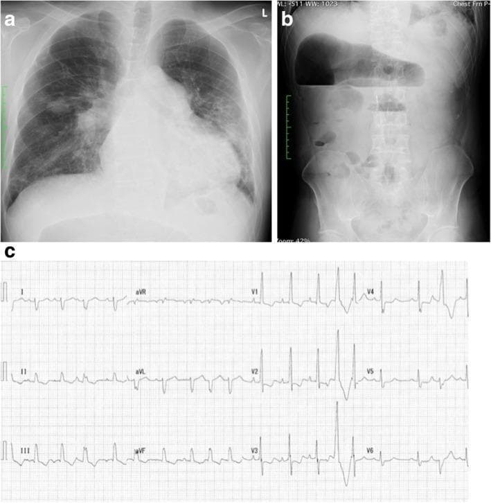 A composite clinical image containing three panels (a, b, and c) illustrating diagnostic findings for a patient with pulmonary hypertension and chronic intestinal paralysis. Panel a is a posterior-anterior (PA) chest radiograph demonstrating significant cardiomegaly with a prominent right-sided heart border and a notably enlarged pulmonary arterial arch, consistent with right heart strain. Panel b is a plain abdominal radiograph in the upright position showing significant gaseous distension within the colon and prominent air-fluid levels, indicating chronic intestinal paralysis or ileus. Panel c is a standard 12-lead electrocardiogram (ECG) showing signs of right ventricular hypertrophy, including a right bundle branch block (RBBB) pattern, right axis deviation, and tall R-waves in the precordial V-leads. Together, these images serve as an educational resource for identifying secondary systemic and cardiac manifestations of chronic thromboembolic pulmonary hypertension and concurrent gastrointestinal complications.