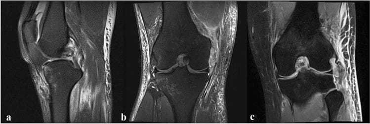 This set of three MRI images of the human knee joint illustrates combined ligamentous injuries. Image (a) is a sagittal view demonstrating an intraligamentous tear of the posterior cruciate ligament (PCL). The image shows discontinuity and high signal intensity within the PCL fibers, accompanied by peri-ligamentous edema. Image (b) is a coronal view displaying a medial collateral ligament (MCL) avulsion from its femoral attachment site, indicative of a posteromedial corner (PMC) injury. Image (c) is a coronal view highlighting a lateral collateral ligament (LCL) avulsion at the fibular attachment, representative of a posterolateral corner (PLC) injury. Both coronal images (b and c) reveal significant soft tissue edema and disruption of the normal dark, linear appearance of the collateral ligaments. These diagnostic images are essential for evaluating complex knee instability and planning surgical interventions such as PCL bracing or ligament augmentation.