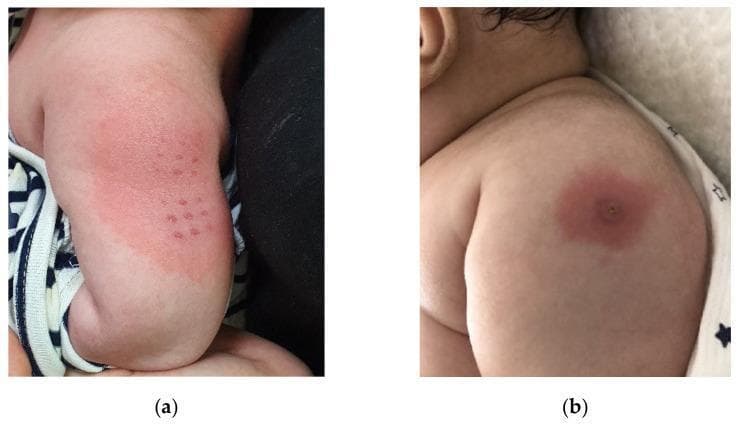 A clinical photograph comparison of two different types of local skin reactions (BCGitis) at the Bacille Calmette-Guerin (BCG) inoculation site on the upper arm of pediatric patients. Image (a) demonstrates erythema following the transdermal delivery method, characterized by a diffuse, irregular patch of redness on the deltoid region containing a grid-like pattern of multiple small, discrete erythematous papules corresponding to the multi-puncture device application. Image (b) shows the reaction following the intradermal delivery method, presenting as a localized, circular erythematous plaque with a solitary, central crusting papule or pustule, often described as a bullseye appearance. These visual manifestations are clinically significant as markers for Kawasaki disease (KD) when observed in febrile infants, representing a specific cutaneous finding known as BCG site reactivation. The image serves as an educational tool for distinguishing between normal and pathological vaccine site inflammation across different administration routes in pediatric dermatology and immunology.