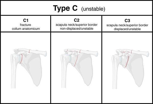 This medical illustration presents a diagnostic classification chart for Type C scapular fractures, characterized as unstable injuries or 'floating shoulder' configurations. The diagram is divided into three panels (C1, C2, C3) showing posterior-anterior views of the right shoulder girdle, highlighting fracture lines in red. Panel C1 illustrates a fracture of the collum anatomicum (anatomical neck) of the scapula. Panel C2 depicts a non-displaced but unstable fracture involving both the scapular neck/superior border and the mid-shaft clavicle. Panel C3 demonstrates a displaced and unstable fracture pattern involving the scapular neck/superior border and the clavicle, with visible misalignment of the bone fragments. The infographic serves as an educational tool for orthopedic trauma, focusing on the Superior Shoulder Suspensory Complex (SSSC) and distinguishing between injury types based on anatomical location and the presence of displacement to determine mechanical stability.