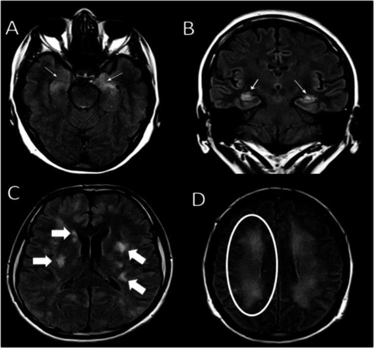 This diagnostic image contains four panels (A-D) displaying brain Magnetic Resonance Imaging (MRI) using the Fluid-Attenuated Inversion Recovery (FLAIR) sequence. The images highlight various hyperintense (bright) lesions associated with neuroinflammatory or demyelinating processes. Panel A (axial) and B (coronal) show symmetric, bilateral hyperintensities within the hippocampi, marked by thin white arrows. Panel C (axial) demonstrates multiple, asymmetrical multifocal hyperintensities involving the cortical, subcortical, and periventricular white matter, indicated by thick white arrows. Panel D (axial) reveals more diffuse, bilateral confluent hyperintense lesions within the frontal lobe white matter, specifically highlighted within a white circle. These findings are clinically significant for evaluating conditions such as autoimmune encephalitis (e.g., anti-NMDA receptor encephalitis) or acute disseminated encephalomyelitis (ADEM). The content is suitable for intermediate to advanced medical education in neurology and radiology, focusing on the visual identification of pathological signal changes in diverse brain regions.