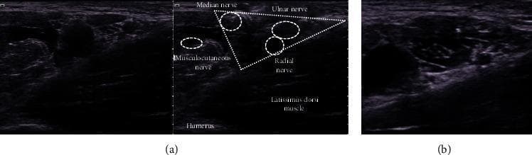 This composite diagnostic image features high-resolution ultrasound views of the axillary region, specifically for ultrasound-guided peripheral nerve blocks. Image (a) provides a labeled transverse cross-section identifying the brachial plexus terminal branches. A dotted white triangle is used as a landmark to group the median, ulnar, and radial nerves, which appear as hypoechoic (dark), circular structures. The musculocutaneous nerve is identified separately to the left, situated within or near the coracobrachialis muscle. Anatomical orientation is established by the latissimus dorsi muscle located inferior to the nerve triangle and the humerus at the base of the scan. Image (b) demonstrates the clinical application of these landmarks, showing the distribution of hypoechoic local anesthetic injected circumferentially around the targeted nerves to ensure an effective block. The image serves as an educational guide for regional anesthesia, highlighting the importance of musculofascial landmarks and the visual contrast between nerves and surrounding hyperechoic connective tissue.