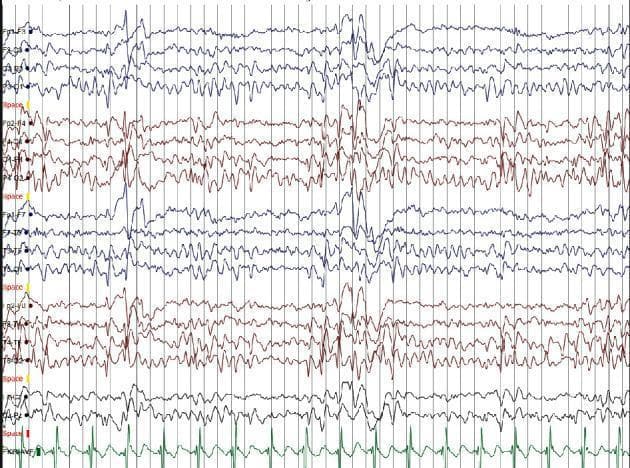 This diagnostic image shows a multi-channel electroencephalogram (EEG) tracing accompanied by a single-lead electrocardiogram (ECG) at the bottom. The EEG illustrates high-amplitude, diphasic spikes and slow-wave complexes. These epileptiform discharges are most prominent in the right centrotemporal region, appearing as sharp, transient deflections against a background of rhythmic baseline activity. The spikes exhibit a horizontal dipole morphology, characterized by distinct upward and downward deflections. A voltage scale of 70 mV/cm is utilized, highlighting the high-voltage nature of the paroxysmal activity. The distribution and morphology of these spikes are classic diagnostic features of Self-Limited Epilepsy with Centrotemporal Spikes (SLECTS). The tracing demonstrates regional predilection with maximal electronegativity in the centrotemporal channels, while the synchronous ECG lead confirms periodic cardiac rhythm alongside the neurological recording. This visual material is used to teach EEG interpretation in pediatric neurology, focusing on focal epilepsy syndromes.