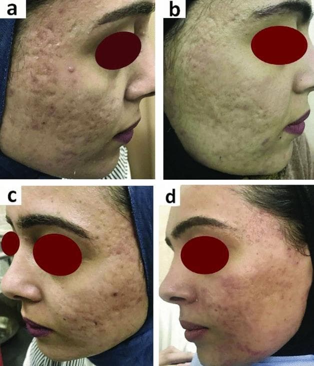 Clinical photographs showing a comparison of facial atrophic acne scars before and after treatment with Platelet-Rich Fibrin (PRF). The image consists of four panels: (a) and (b) depict the right cheek, while (c) and (d) depict the left cheek. Panels (a) and (c) establish baseline clinical features, including high density atrophic scarring—specifically ice-pick, boxcar, and rolling scars—accompanied by visible post-inflammatory hyperpigmentation (PIH) and uneven skin texture. Panels (b) and (d) demonstrate post-treatment outcomes. The right side (b) was treated with combined fluid PRF and skin needling, showing a significant reduction in scar depth and improved skin contour. The left side (d) was treated with intradermal PRF injection alone, illustrating a notable decrease in erythema and PIH with smoother epidermal texture. The set serves as a comparative study in dermatology for evaluating non-surgical interventions for acne-induced skin remodeling and the efficacy of different PRF delivery methods.