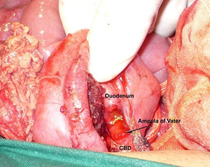 This clinical photograph captures an intraoperative view of the upper gastrointestinal and hepatobiliary systems during a surgical procedure. The operative field focuses on the duodenum and the extrahepatic biliary tract. Key anatomical structures are labeled, including the duodenum, the common bile duct (CBD), and the ampulla of Vater. The visual evidence shows a partial avulsion of the common bile duct near its insertion point at the duodenum. Clinical findings include significant tissue disruption, hematoma formation, and active bleeding in the periductal area, suggesting traumatic injury. The duodenum appears edematous and erythematous. A gloved hand is visible performing surgical retraction to expose the site of injury, and green surgical drapes border the inferior aspect of the field. This image serves as a clinical specimen illustration for hepatobiliary surgery, emergency trauma management, and the anatomical relationship between the biliary tree and the second part of the duodenum.
