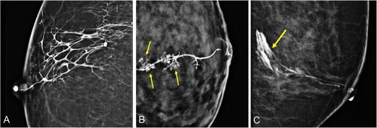 This composite of diagnostic images displays breast ductograms (galactograms) highlighting the ductal anatomy and contrast distribution. Image A shows a normal ductogram in a craniocaudal (CC) view, where radiopaque contrast material fills the primary lactiferous duct at the nipple and branches extensively throughout the breast parenchyma, demonstrating system patency. Image B is a close-up highlighting a 'lobular blush' (indicated by yellow arrows), which represents contrast material successfully filling the terminal ductal lobular units (TDLU), appearing as small, clustered, stippled areas of enhancement. Image C is a 90-degree mediolateral ductogram demonstrating iatrogenic extravasation (yellow arrow) where contrast material has leaked from the ductal system into the surrounding interstitial tissue, often caused by excessive injection pressure. These images are used in breast imaging to evaluate nipple discharge, identify intraductal lesions such as papillomas, and map ductal anatomy prior to surgical intervention. The modality is X-ray mammography following ductal cannulation and contrast injection.