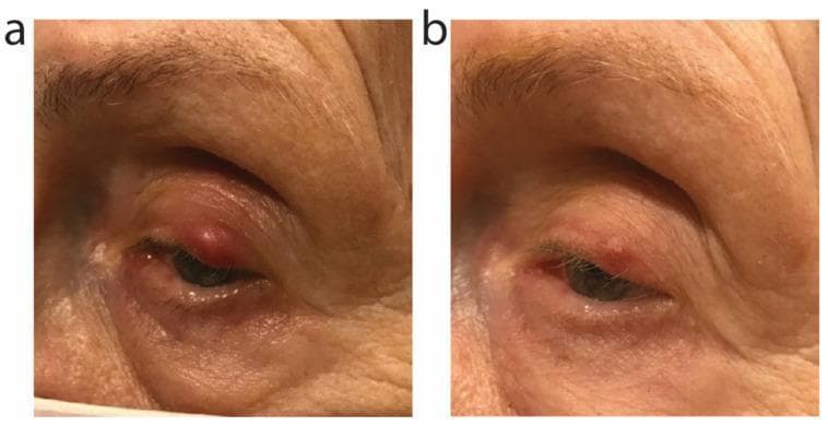 Clinical photograph comparison of the left eye in an adult patient, demonstrating the progression and treatment of an external hordeolum (stye) associated with ocular rosacea. Image (a) shows the baseline presentation: a prominent, well-circumscribed, erythematous, and edematous nodule located on the margin of the left upper eyelid. There is visible peri-orbital erythema and inflammatory swelling of the surrounding skin. Image (b) shows clinical improvement 15 days later, following a 9-day course of oral sarecycline. The lesion exhibits a significant reduction in volume, height, and vascular congestion. The surrounding skin shows resolution of the inflammatory edema and a return to a more natural texture and color. This comparison illustrates the efficacy of tetracycline-class antibiotics in managing painful inflammatory eyelid lesions by reducing both bacterial load and localized inflammation. Educational focus includes ophthalmology, dermatology, and the clinical response of staphylococcal infections or ocular rosacea to systemic antibiotic therapy.