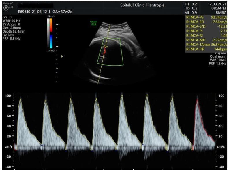 This diagnostic image is a Doppler ultrasound of the fetal middle cerebral artery (MCA), commonly used in maternal-fetal medicine to assess for fetal anemia or hypoxia. The display is divided into a B-mode ultrasound view showing the fetal head and circle of Willis in the upper portion, and a spectral Doppler waveform in the lower portion. The spectral waveform exhibits high-resistance flow characterized by sharp systolic peaks and absent-to-reversed end-diastolic flow (AREDF), where the signal descends to or below the zero-velocity baseline. Numerical measurements on the right indicate a peak systolic velocity (PSV) of 92.34 cm/s and an end-diastolic velocity (ED) of -7.56 cm/s, resulting in a high pulsatility index (PI) of 2.71 and a resistance index (RI) of 1.08. These findings are clinically significant as an elevated MCA-PSV is a primary screening marker for severe fetal anemia, while the reversal of diastolic flow indicates significant hemodynamic compromise or high downstream resistance.