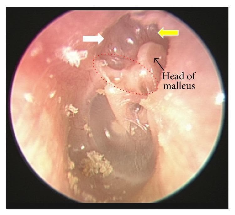 This endoscopic clinical photograph displays the left tympanic membrane, illustrating signs of chronic middle ear disease. The image focuses on the superior attic region (pars flaccida). A white arrow identifies an attic retraction pocket, where the tympanic membrane is invaginated medially. A red dotted circle highlights an atelectatic Prussak's space, indicating a localized collapse of the membrane. Adjacent to this, a yellow arrow points to an eroded scutum, showing loss of the bony lateral attic wall. The head of the malleus is visible and labeled due to the loss of overlying structural integrity. These findings are characteristic precursors or manifestations of acquired cholesteatoma, reflecting chronic negative middle ear pressure and inflammatory bone resorption. The image serves as a clinical example for otolaryngology education regarding the diagnosis of middle ear pathology and the assessment of structural damage to the ossicular chain and surrounding bony landmarks.