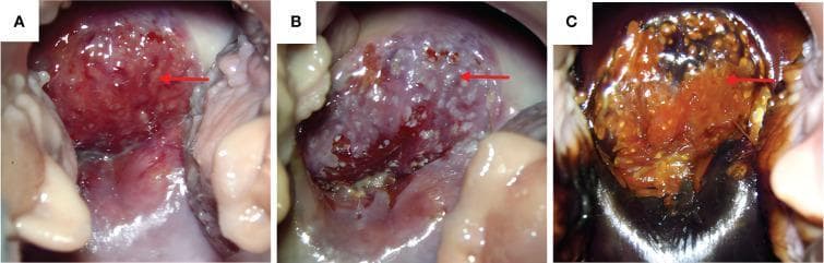 A series of colposcopy clinical photographs (labeled A, B, and C) depicting a uterine cervix with high-grade pathology. (A) Baseline colposcopy shows significant erosion-like changes in the anterior cervical lip with pronounced vascular proliferation and a friable, reddened surface (red arrow). (B) Following the application of acetic acid (vinegar test), the lesion demonstrates positive acetowhite changes, appearing as opaque white spots. In this same region, atypical vascular patterns including mosaic blood vessels are clearly visible. (C) Following the application of Lugol's iodine (Schiller test), the anterior cervical lip remains iodine-negative (unstained), retaining its original color while the surrounding normal tissue or vaginal vault displays dark staining. This lack of iodine uptake indicates a lack of glycogen, which is characteristic of dysplastic or malignant squamous epithelium. These visual findings are consistent with High-grade Squamous Intraepithelial Lesion (HSIL) or invasive Squamous Cell Carcinoma (SCC).