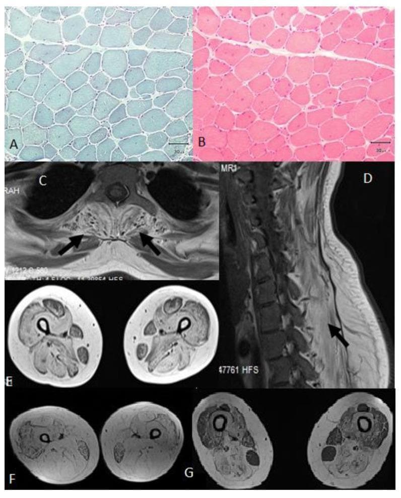 This composite figure integrates light microscopy of muscle biopsies and clinical MRI scans illustrating a plectin-related muscular dystrophy. Panels (A) and (B) present transverse sections of deltoid muscle biopsy using different stains. (A) shows polygonal muscle fibers with bluish immunohistochemical staining, while (B) shows H&E-stained rounded muscle fibers. Both highlight myopathic features including over 10% internal nuclei and angular atrophic fibers. Panels (C-G) are T1-weighted MRI sequences. (C) and (D) provide axial and sagittal views of the spine, respectively, with arrows indicating fatty infiltration of the paraspinal muscles. Panels (E), (F), and (G) are axial views of the thighs showing varying degrees of muscular pathology. (F) demonstrates advanced fatty transformation of the hamstrings and adductors, while (G) shows selective fatty replacement in the adductor magnus, adductor longus, biceps femoris, semitendinosus, and semimembranosus. Throughout the MRI series, a consistent clinical sign is the relative sparing of the rectus femoris, gracilis, and sartorius muscles, which is a characteristic diagnostic pattern for certain limb-girdle muscular dystrophies and congenital myasthenic syndromes.
