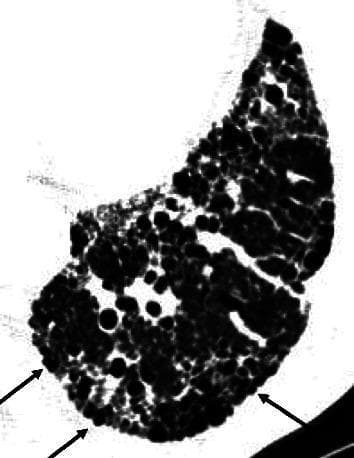High-resolution computed tomography (HRCT) axial view of the lung parenchyma demonstrating classic honeycombing patterns associated with Usual Interstitial Pneumonia (UIP). The image shows clustered, subpleural cystic airspaces with thick, well-defined walls. These cysts appear as rounded or oval lucencies (dark regions) interspersed with bright, high-density fibrotic tissue. A key diagnostic feature highlighted by black arrows is the outward protuberance of these honeycomb cysts toward the extrapulmonary region, distorting the pleural surface. The distribution is predominantly peripheral and subpleural, creating a heterogeneous architectural distortion typical of end-stage pulmonary fibrosis. This visual serves as an educational tool to differentiate honeycombing in UIP from the more uniform traction bronchiolectasis seen in Nonspecific Interstitial Pneumonia (NSIP), where such pleural protuberance is typically absent.