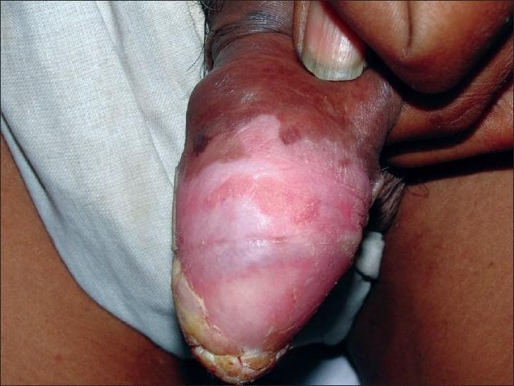 Clinical photograph of the glans penis in an uncircumcised male, showing a significant dermatological lesion on the dorsal surface. The primary finding is a large, well-demarcated erythematous plaque involving a substantial portion of the glans. Centrally and superiorly, the lesion displays areas of hyperkeratosis with white, mica-like scaling and a thickened, verrucous texture. The surrounding base is intensely erythematous. A finger is visible retracting the foreskin to expose the extent of the pathology. This presentation is characteristic of pseudoepitheliomatous keratotic and micaceous balanitis (PKMB), often clinically resembling penile psoriasis or Bowen's disease but distinguished by its aggressive, verrucous growth and thick scaling. The image serves as an educational tool for identifying premalignant or hypertrophic penile skin conditions in urology and dermatology.