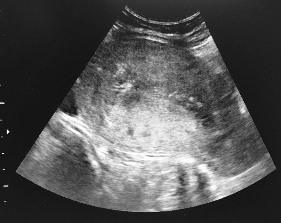 This diagnostic image is a transabdominal ultrasound of the pelvis, focusing on the uterus. The scan reveals a significantly enlarged uterine cavity filled with complex, heterogeneous tissue. The echotexture is characterized by a 'snowstorm' appearance, consisting of numerous small, hypoechoic (cystic) spaces interspersed with hyperechoic (echogenic) areas, suggesting solid components or blood clots. The margins of the intrauterine mass are irregular and poorly defined, with no evidence of a healthy gestational sac or normal endometrial strip. This visual presentation is highly characteristic of gestational trophoblastic disease (GTD), such as a hydatidiform mole. The image demonstrates the clinical utility of real-time ultrasound guidance during a dilatation and curettage (D&C) procedure to monitor the evacuation of abnormal uterine contents and ensure the safety of the uterine wall. The primary educational focus is the sonographic identification of abnormal molar pregnancy tissue and the management of high-beta-hCG pelvic masses.